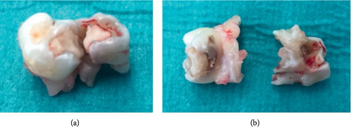 Brain Abscess Secondary to a Dental Infection.