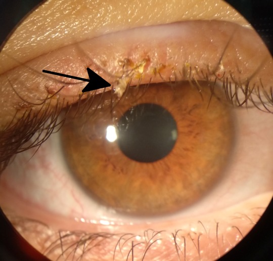 Itching eyes after itching around the head.