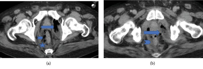 Ruptured Obturator Internus Muscle Abscess Causing Extensive Retroperitoneal Necrosis.