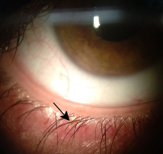 Itching eyes after itching around the head.