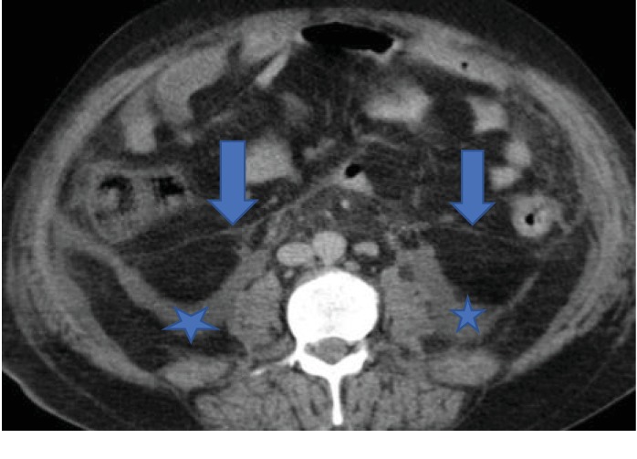 Ruptured Obturator Internus Muscle Abscess Causing Extensive Retroperitoneal Necrosis.