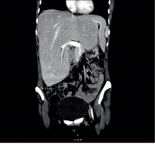 Hepatocellular Glycogen Accumulation in the Setting of Poorly Controlled Type 1 Diabetes Mellitus: Case Report and Review of the Literature.
