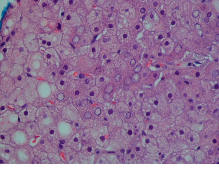 Hepatocellular Glycogen Accumulation in the Setting of Poorly Controlled Type 1 Diabetes Mellitus: Case Report and Review of the Literature.