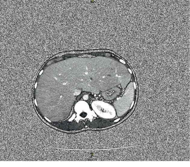 Hepatocellular Glycogen Accumulation in the Setting of Poorly Controlled Type 1 Diabetes Mellitus: Case Report and Review of the Literature.