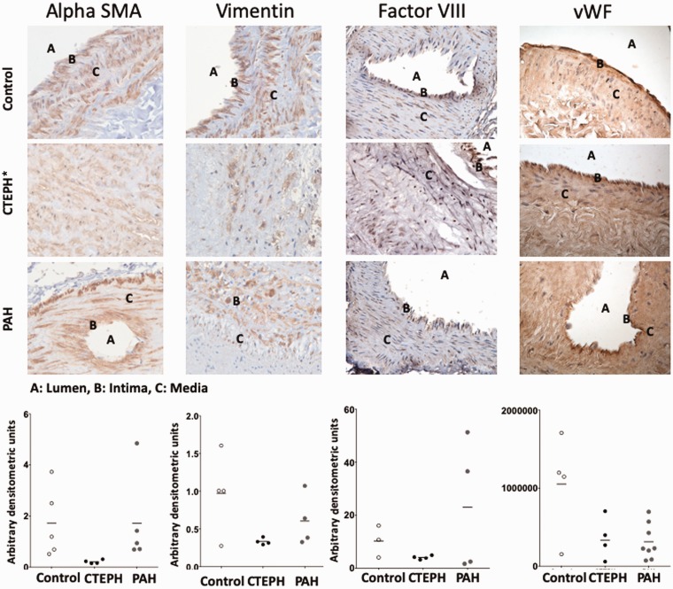 A multifaceted investigation into molecular associations of chronic thromboembolic pulmonary hypertension pathogenesis.