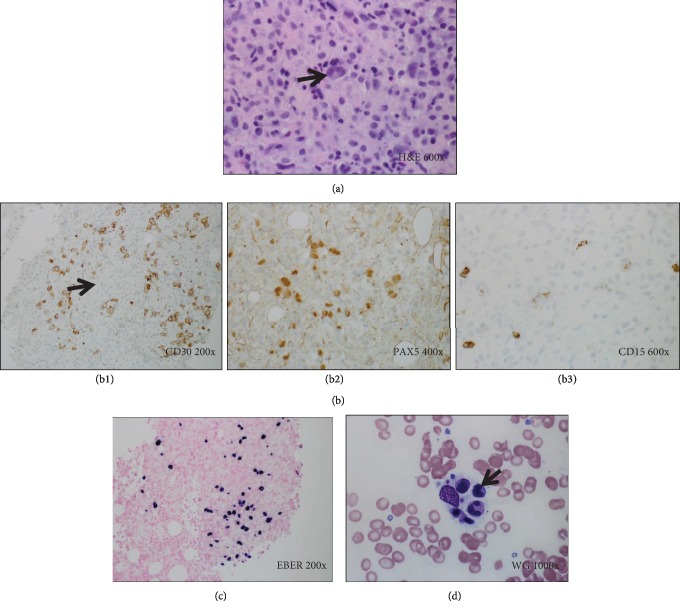 Late-Onset Posttransplant Lymphoproliferative Disorders after Solid Organ Transplantation in Adults: A Case Series and Review of the Literature.