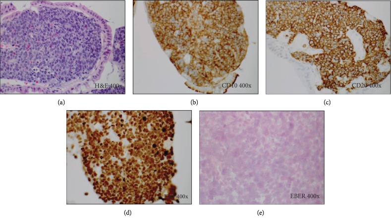 Late-Onset Posttransplant Lymphoproliferative Disorders after Solid Organ Transplantation in Adults: A Case Series and Review of the Literature.