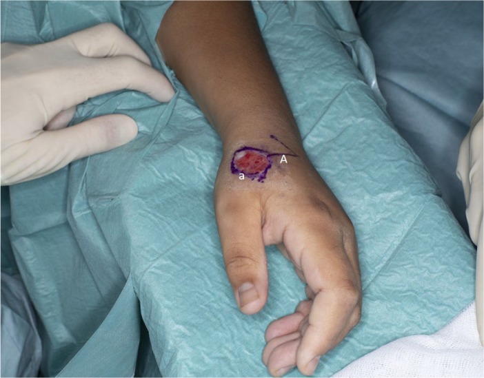 A full-thickness chemical burn to the hand using formic acid-based anti-wart treatment: a case report and literature review.