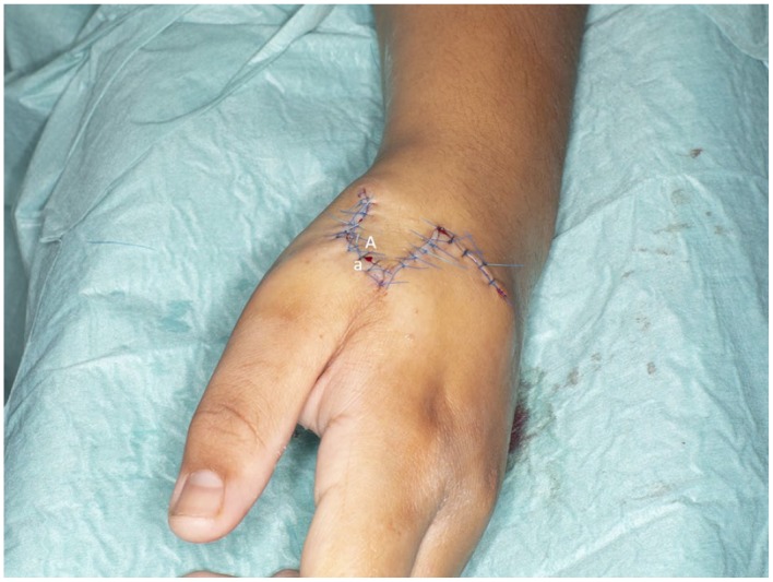 A full-thickness chemical burn to the hand using formic acid-based anti-wart treatment: a case report and literature review.