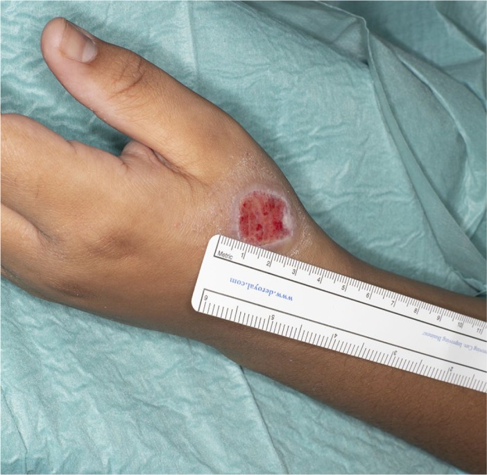 A full-thickness chemical burn to the hand using formic acid-based anti-wart treatment: a case report and literature review.