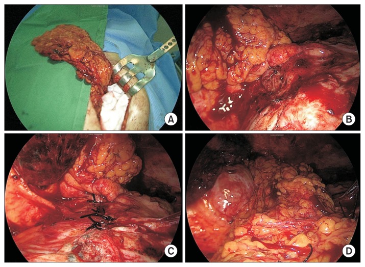Surgical Treatment of Bronchobiliary Fistula with Pulmonary Resection and Omentopexy.