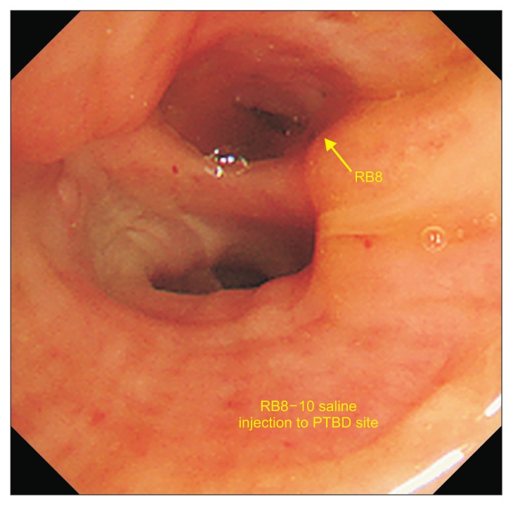 Surgical Treatment of Bronchobiliary Fistula with Pulmonary Resection and Omentopexy.
