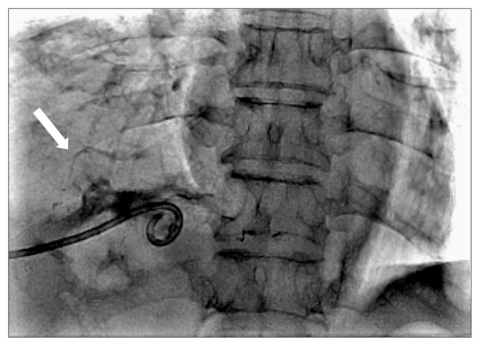 Surgical Treatment of Bronchobiliary Fistula with Pulmonary Resection and Omentopexy.