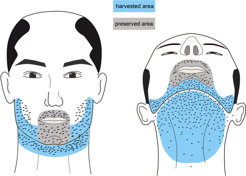 Large-Scale Beard Extraction Enhances the Cosmetic Results of Scalp Hair Restoration in Advanced Androgenetic Alopecia in East Asian Men: A Retrospective Study.