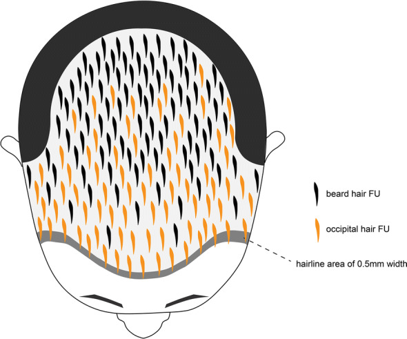 Large-Scale Beard Extraction Enhances the Cosmetic Results of Scalp Hair Restoration in Advanced Androgenetic Alopecia in East Asian Men: A Retrospective Study.