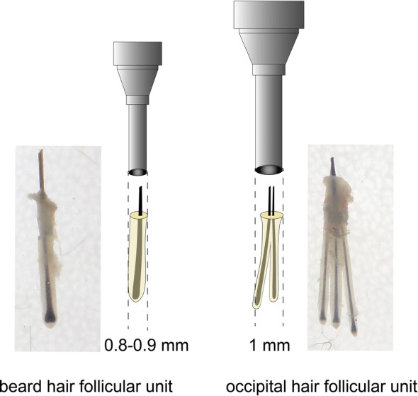 Large-Scale Beard Extraction Enhances the Cosmetic Results of Scalp Hair Restoration in Advanced Androgenetic Alopecia in East Asian Men: A Retrospective Study.