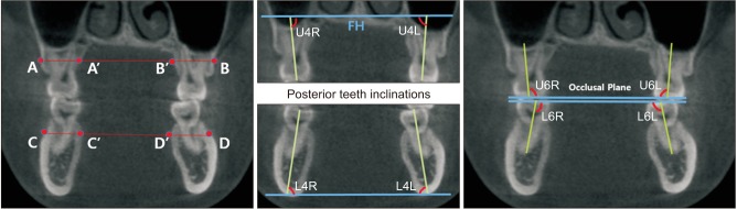 Posterior dental compensation and occlusal function in adults with different sagittal skeletal malocclusions.