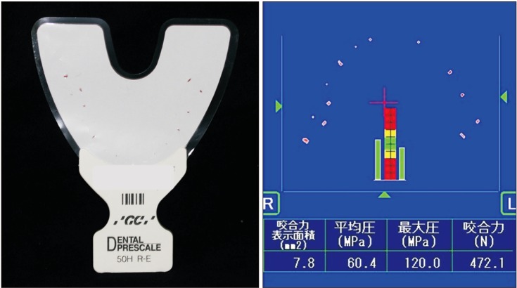 Posterior dental compensation and occlusal function in adults with different sagittal skeletal malocclusions.