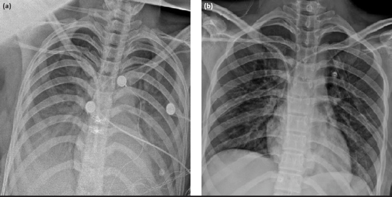 Successful single-pass albumin dialysis in the management of severe calcium channel blocker poisoning.