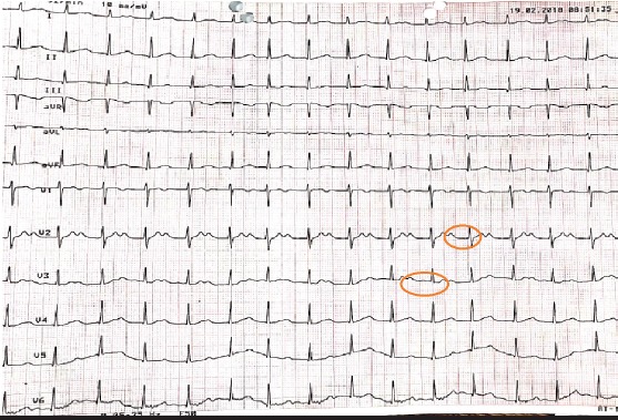 Successful single-pass albumin dialysis in the management of severe calcium channel blocker poisoning.