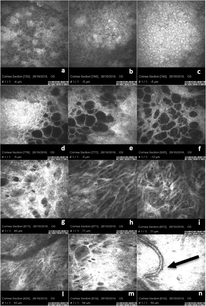 In vivo confocal microscopy: qualitative investigation of the conjunctival and corneal surface in open angle glaucomatous patients undergoing the XEN-Gel implant, trabeculectomy or medical therapy.
