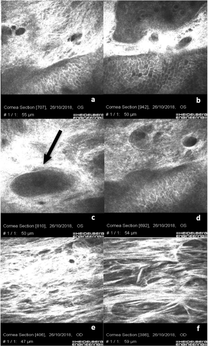 In vivo confocal microscopy: qualitative investigation of the conjunctival and corneal surface in open angle glaucomatous patients undergoing the XEN-Gel implant, trabeculectomy or medical therapy.