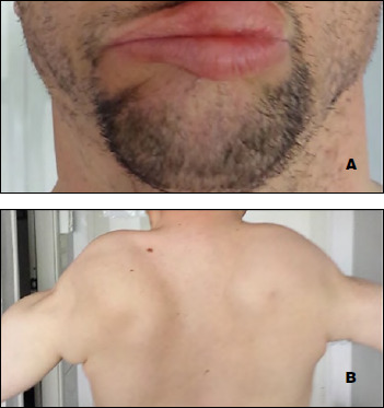 Facioscapulohumeral muscular dystrophy (FSHD) and multiple sclerosis: a case report.