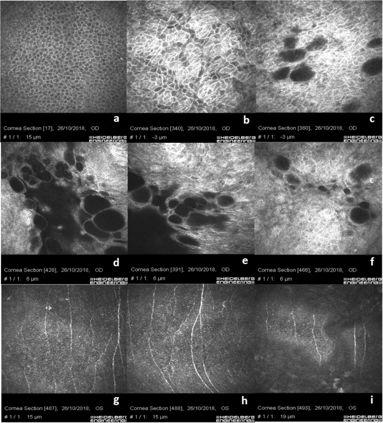 In vivo confocal microscopy: qualitative investigation of the conjunctival and corneal surface in open angle glaucomatous patients undergoing the XEN-Gel implant, trabeculectomy or medical therapy.