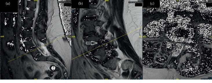 A Transforaminal Endoscopic Surgical Technique for Treating Lumbar Disc Herniation in the Setting of Spina Bifida.