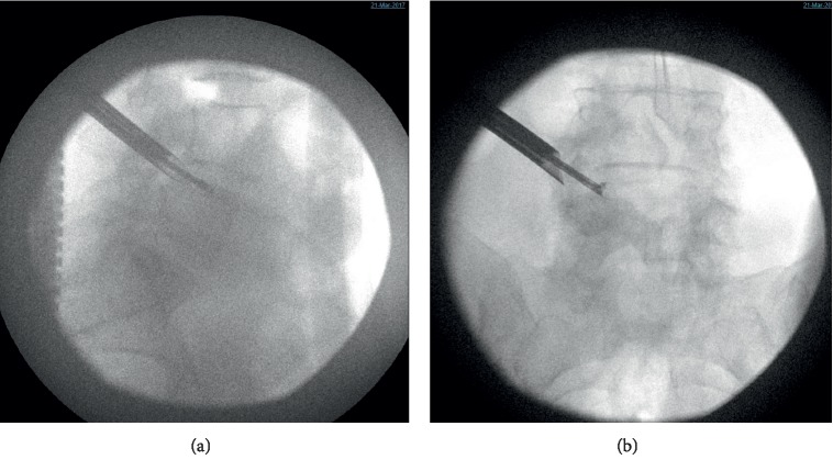 A Transforaminal Endoscopic Surgical Technique for Treating Lumbar Disc Herniation in the Setting of Spina Bifida.