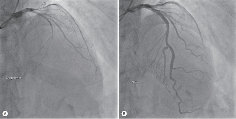 Recurrent Coronary Artery Vasospasm in a Patient with Hepatocellular Carcinoma Treated with Sorafenib: a Case Report and Literature Review.