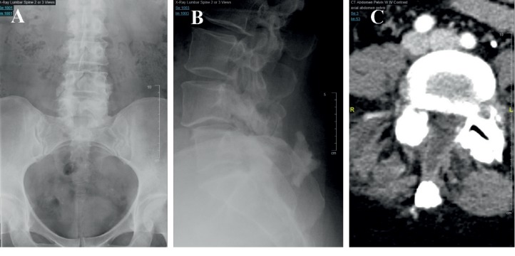 A Transforaminal Endoscopic Surgical Technique for Treating Lumbar Disc Herniation in the Setting of Spina Bifida.