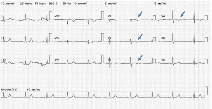 Recurrent Coronary Artery Vasospasm in a Patient with Hepatocellular Carcinoma Treated with Sorafenib: a Case Report and Literature Review.