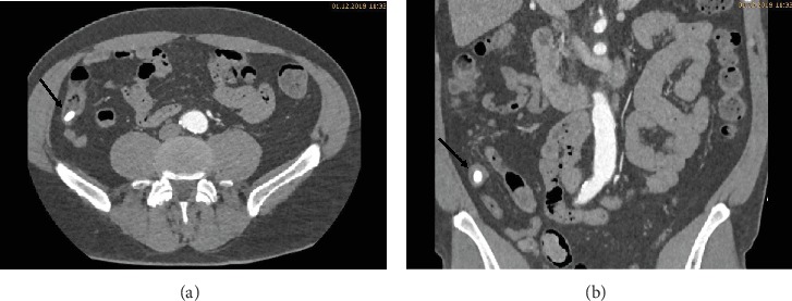 A Degrading Potassium Tablet Mimicking Active Gastric Bleeding in a Computer Tomographic Investigation.