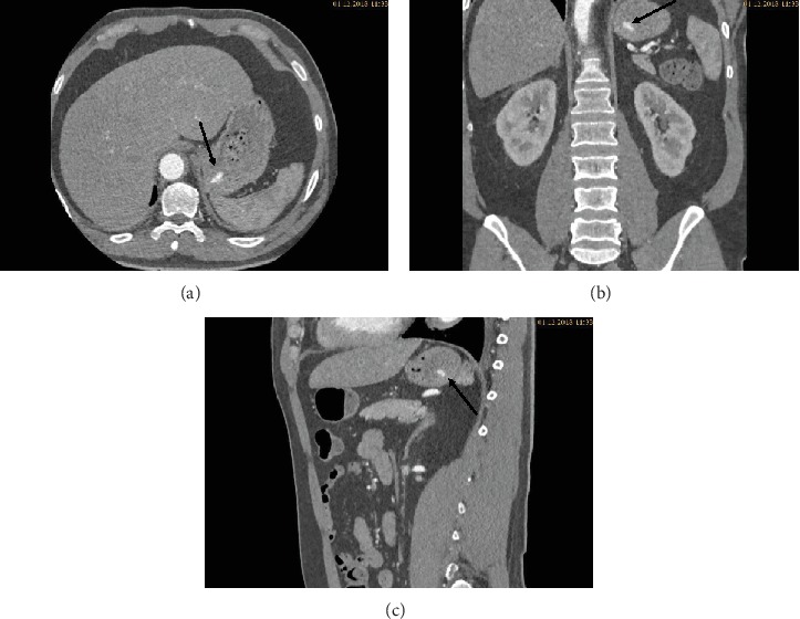 A Degrading Potassium Tablet Mimicking Active Gastric Bleeding in a Computer Tomographic Investigation.