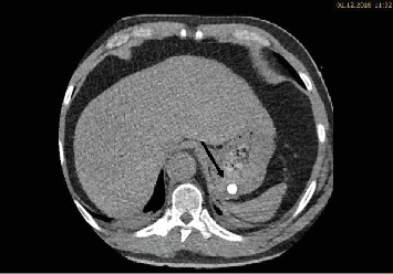 A Degrading Potassium Tablet Mimicking Active Gastric Bleeding in a Computer Tomographic Investigation.