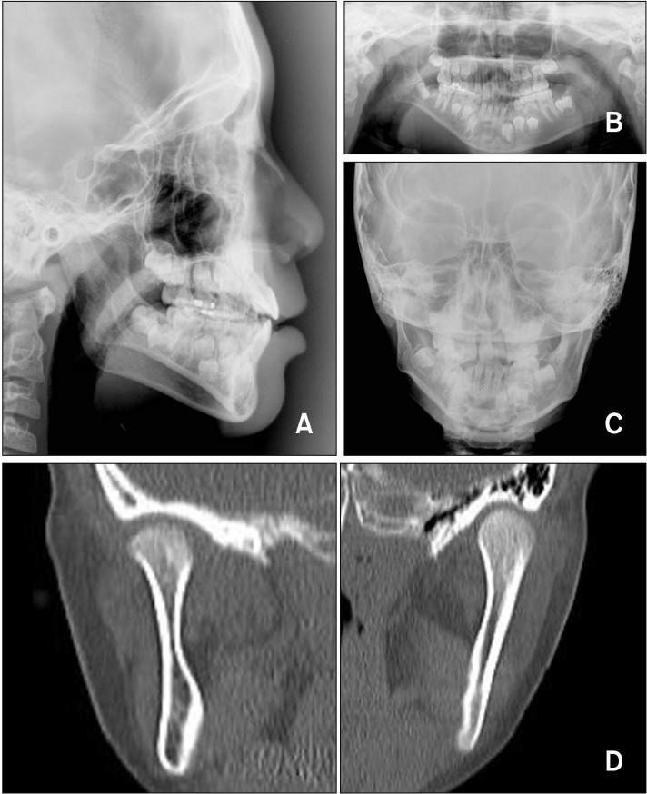 Growth observation and orthodontic treatment of a hemifacial microsomia patient treated with distraction osteogenesis.