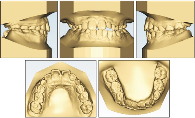 Growth observation and orthodontic treatment of a hemifacial microsomia patient treated with distraction osteogenesis.