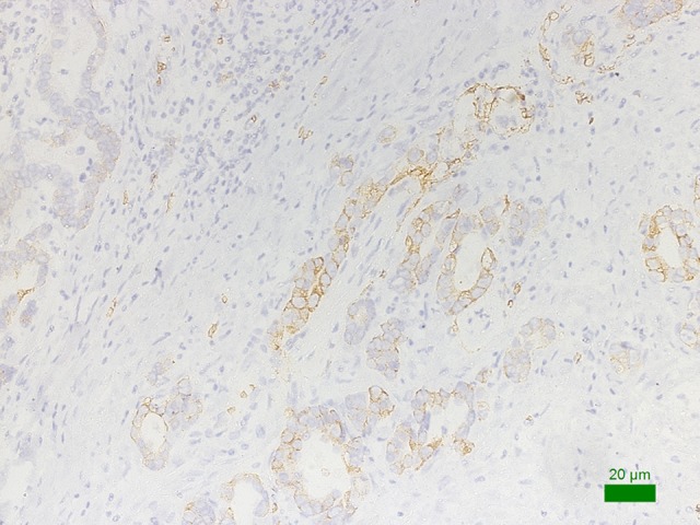 Glucose Transporter-1 (GLUT-1) Expression is Associated with Tumor Size and Poor Prognosis in Locally Advanced Gastric Cancer.