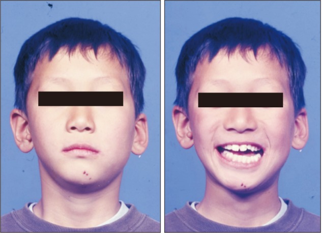 Growth observation and orthodontic treatment of a hemifacial microsomia patient treated with distraction osteogenesis.