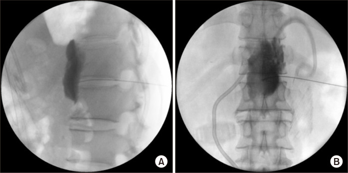 Celiac Plexus Neurolysis for the Treatment of Patients with Terminal Cancer at a Tertiary University Hospital in Korea.