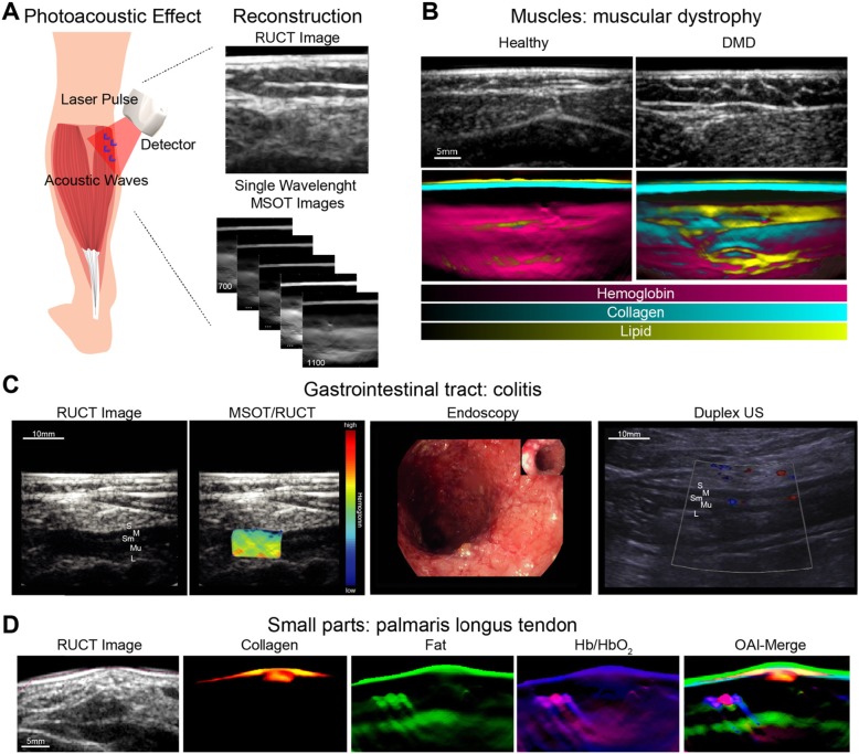 Shedding light on pediatric diseases: multispectral optoacoustic tomography at the doorway to clinical applications.