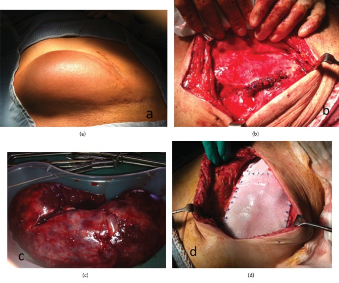 Biological Mesh Repair of a Large Incisional Hernia Containing a Kidney Transplant in the Presence of Inflammation.