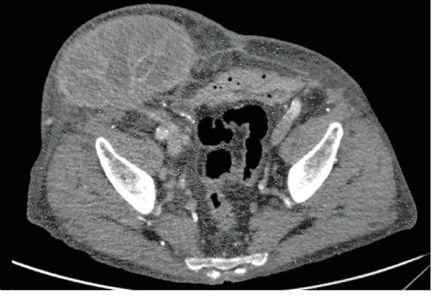 Biological Mesh Repair of a Large Incisional Hernia Containing a Kidney Transplant in the Presence of Inflammation.