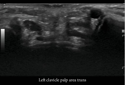 Ganglion of the Sternoclavicular Joint: A Rare Location of an Uncommon Pediatric Mass.