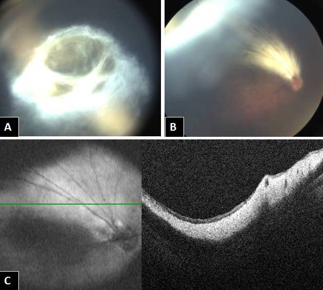 Retrolental fibroplasias: What lies beneath?