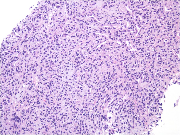 A challenging case of Mesenchymal Chondrosarcoma involving the thyroid and special considerations for diagnosis.