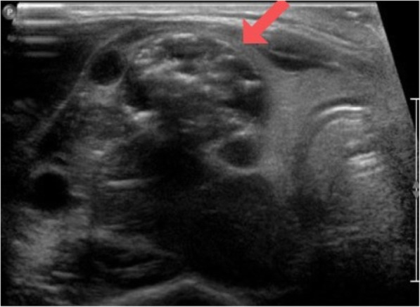 A challenging case of Mesenchymal Chondrosarcoma involving the thyroid and special considerations for diagnosis.