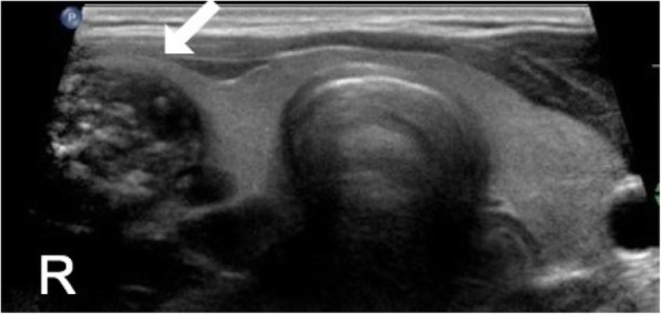 A challenging case of Mesenchymal Chondrosarcoma involving the thyroid and special considerations for diagnosis.