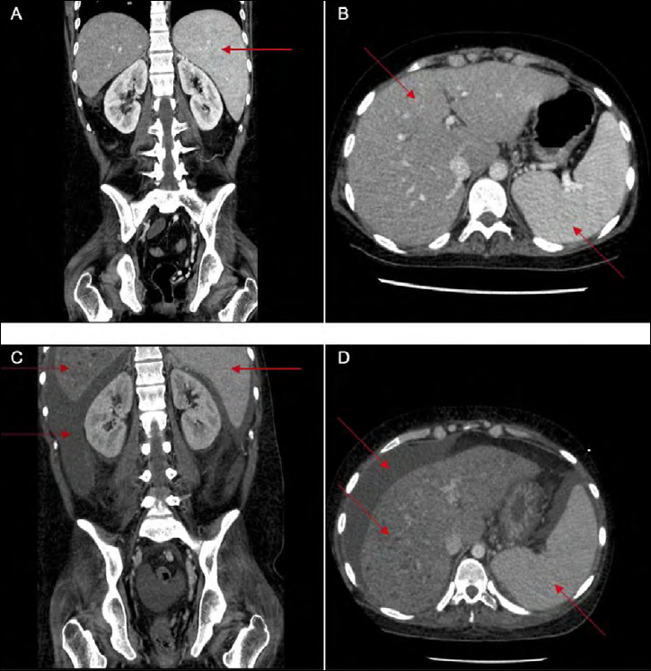 Late-onset MADD: a rare cause of cirrhosis and acute liver failure?